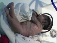Dameer: Birth defects increased in Gaza due to Israel’s use of chemical weapons